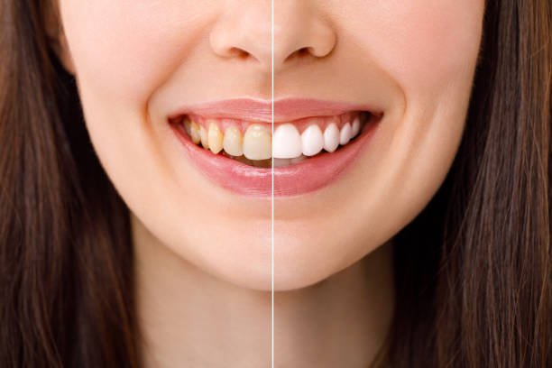 Comparação de sorriso antes e depois