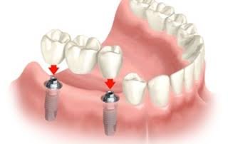 Ilustração de tratamento com implantes dentários